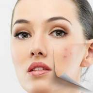 Tretmani čišćenja lica u sklopu terapije akni